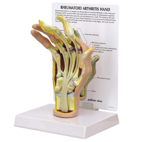 Gpi Anatomical Anatomical Model - Hand - Rheumatoidarthritis 1931